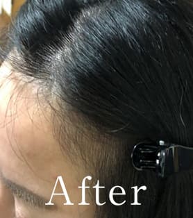 20代女性 発毛施術アフター